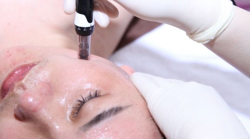 Nano-microneedles Facial