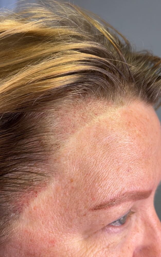 Scalp Micropigmentation (SMP)