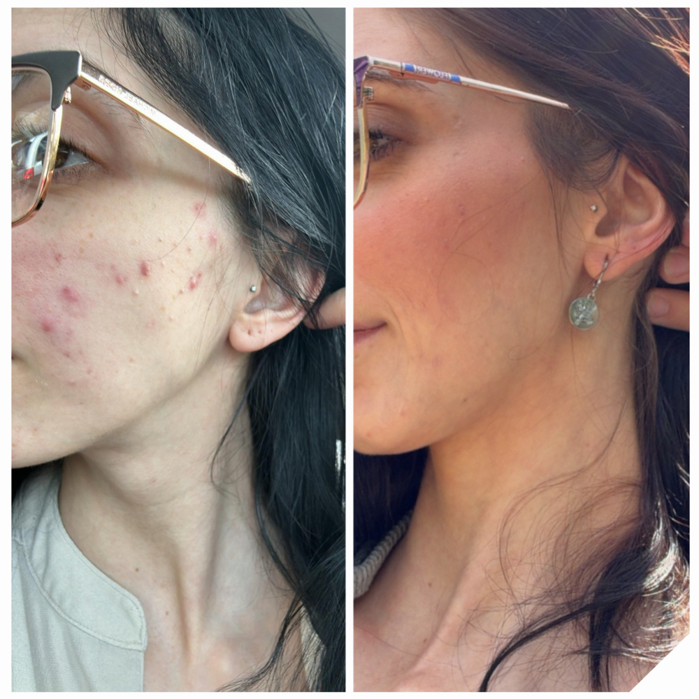 Acne Clearing Facial at Blush & Bloom in Claremore, OK