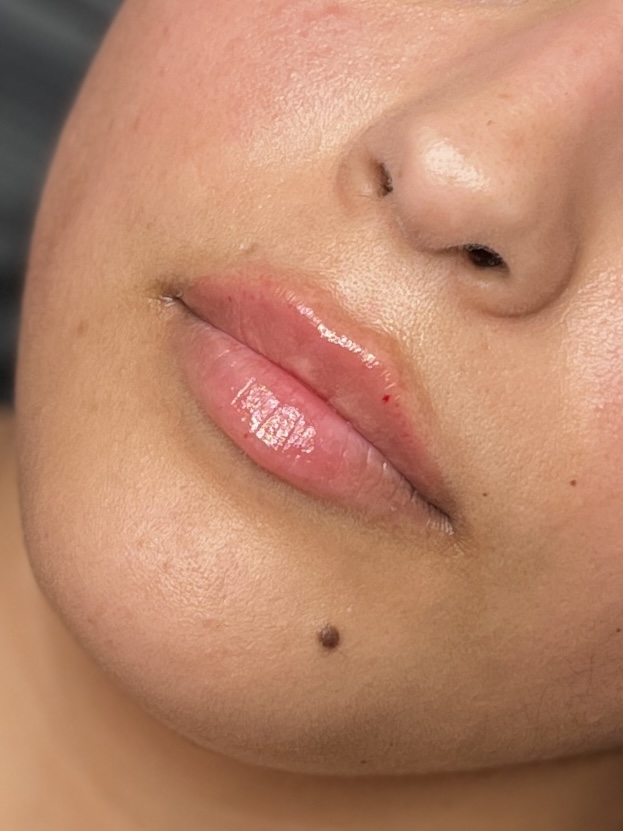 1/2 syringe Lip Filler