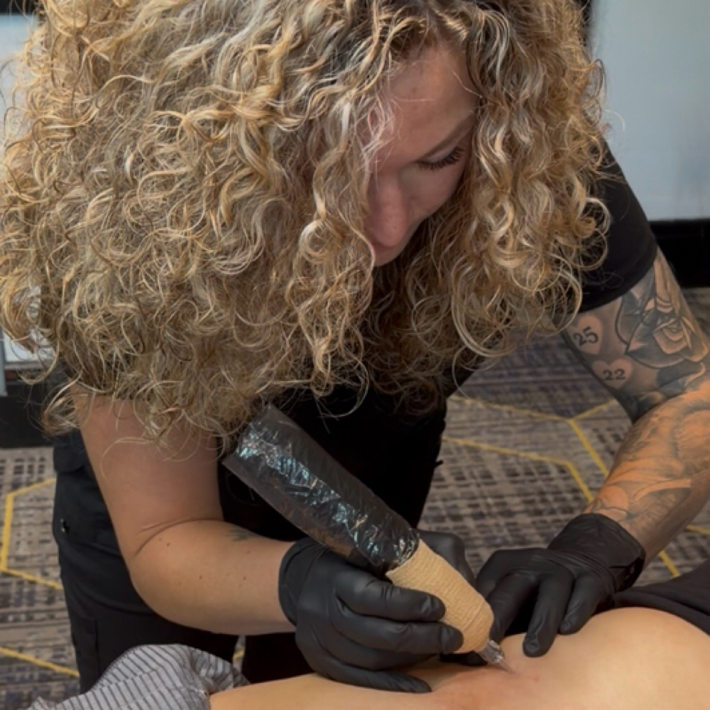 Stretch Mark & Scar Rejuvenation at SkinWorks & Co. in Gun Barrel City, TX