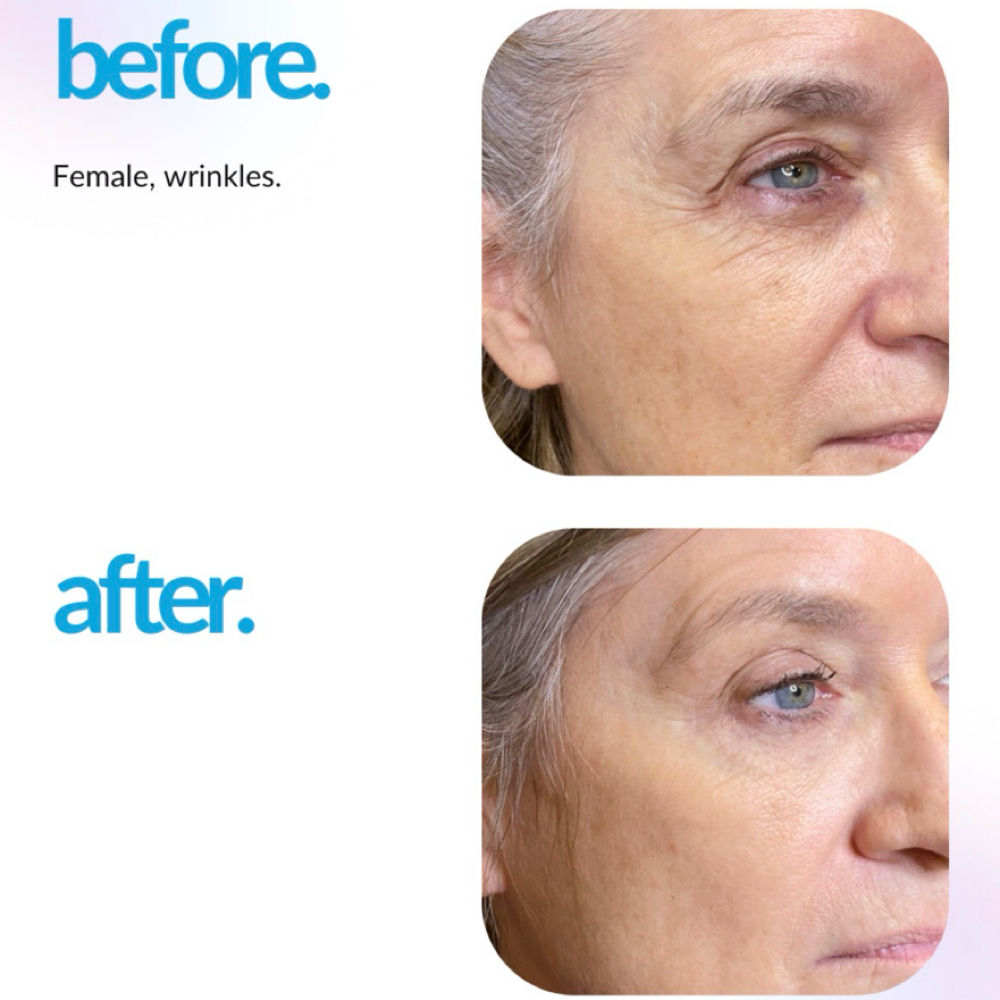 Eye Lift Microchanneling at Thais Leal Skin Studio in Osterville, MA