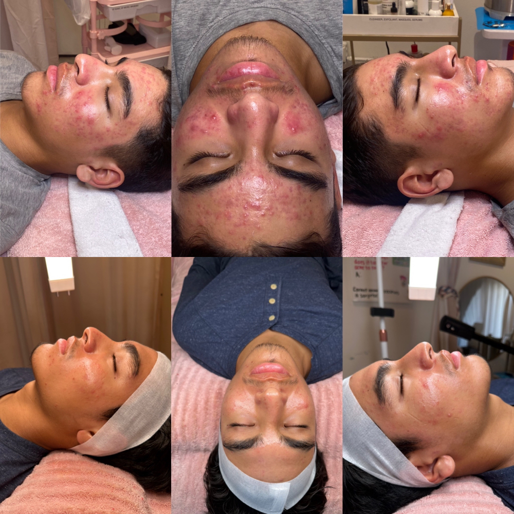 Acne Facial