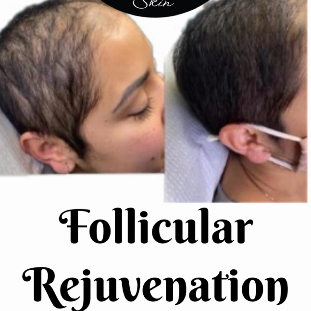 Hair Loss Advance Treatment at Potent Transitions in East Orange, NJ