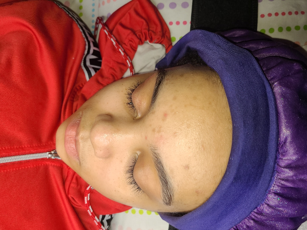 Teen Acne Facial