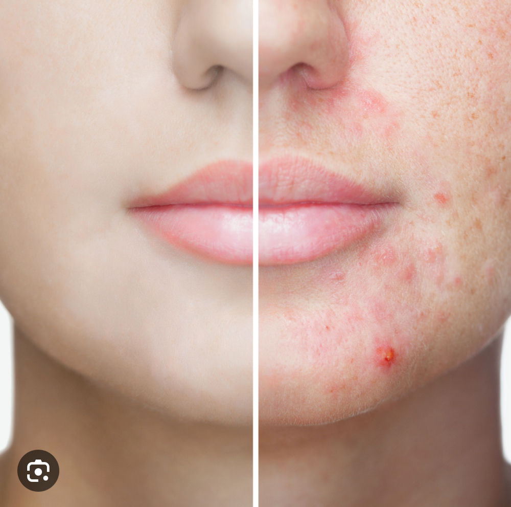 Acne Facial