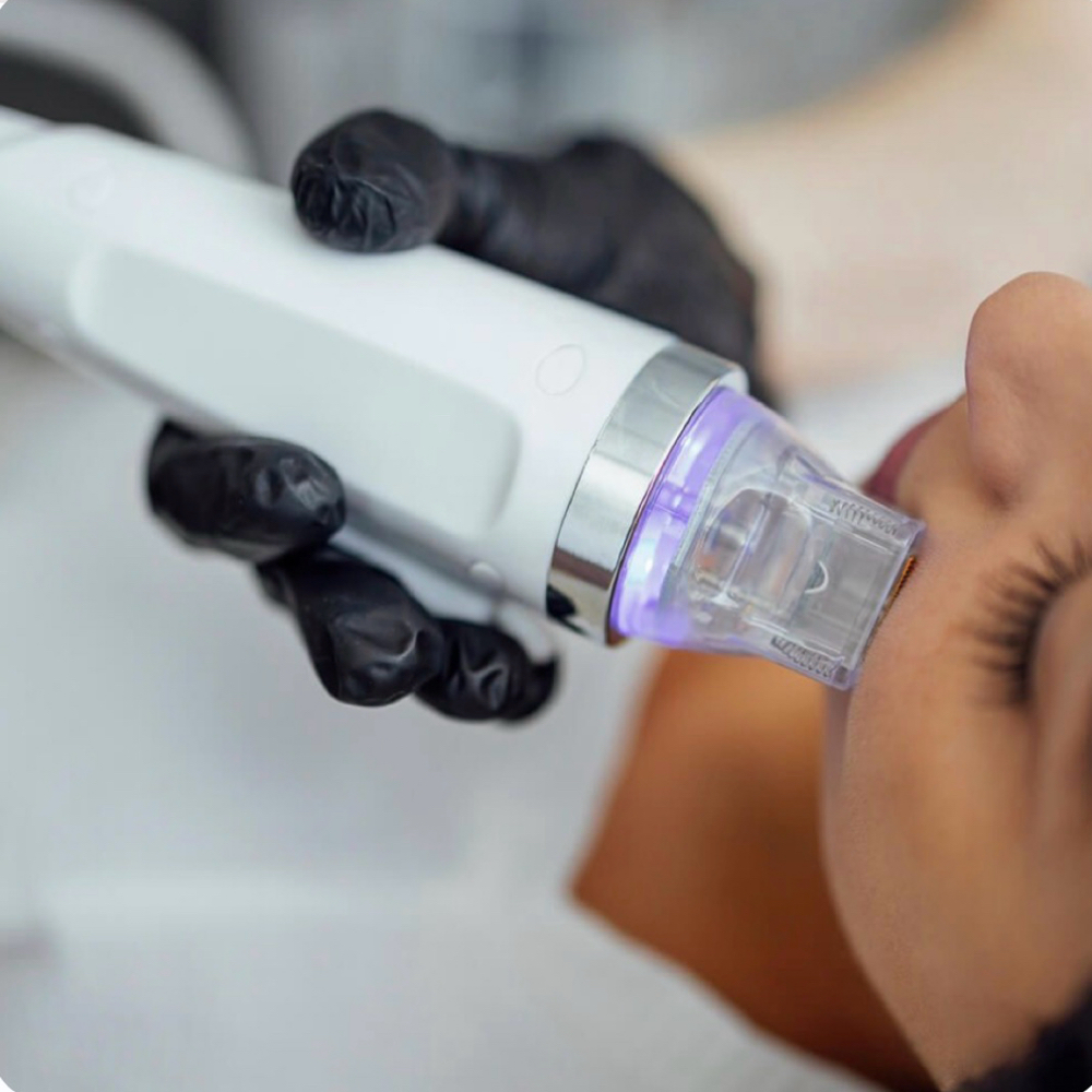 Potenza Scar Treatment at Good Skin Co. in Sarasota, FL