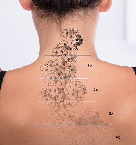 Tattoo Removal Medium Area
