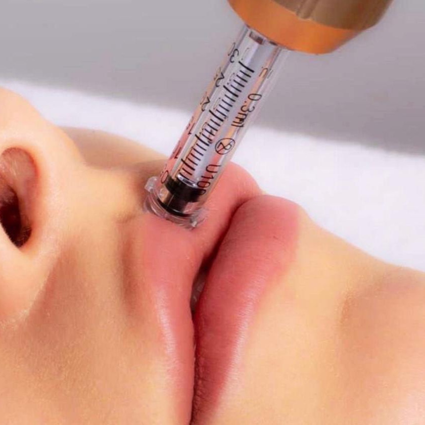 Hyaluron Lip Filler Touch Up