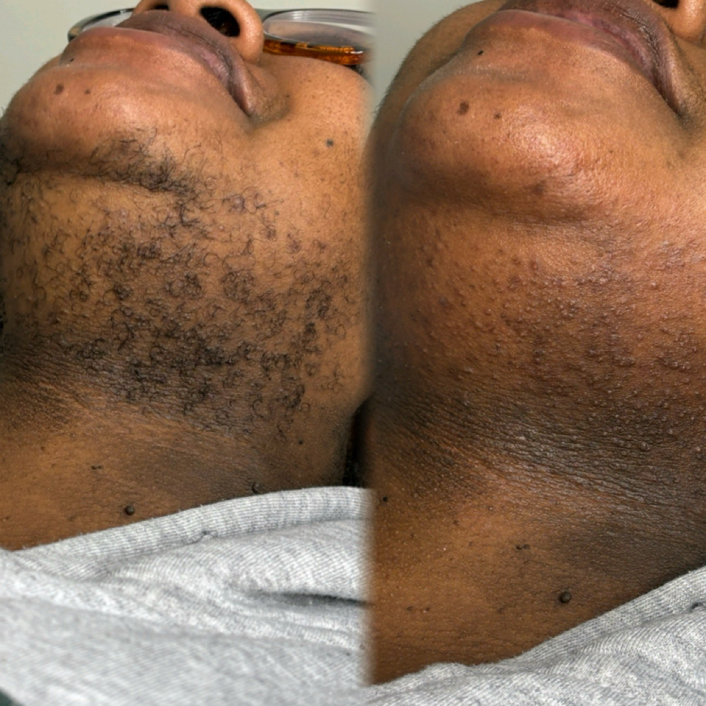 Chin & Neck Wax at Faced Aesthetics LLC in Riverdale, GA