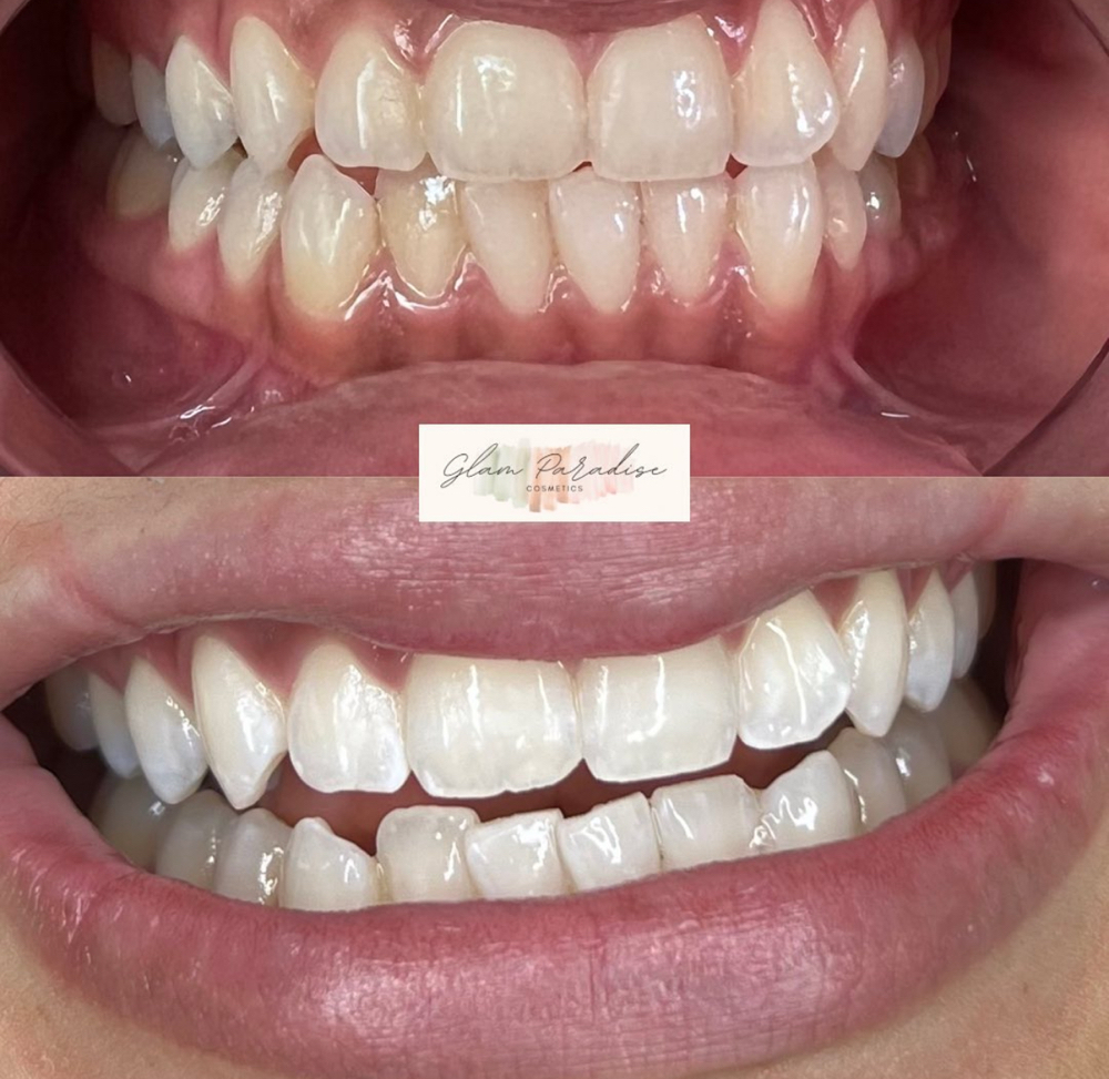Brilliance Whitening