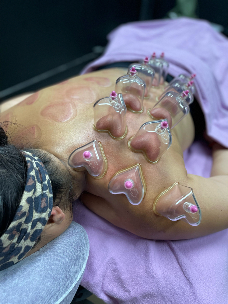 Cupping Only