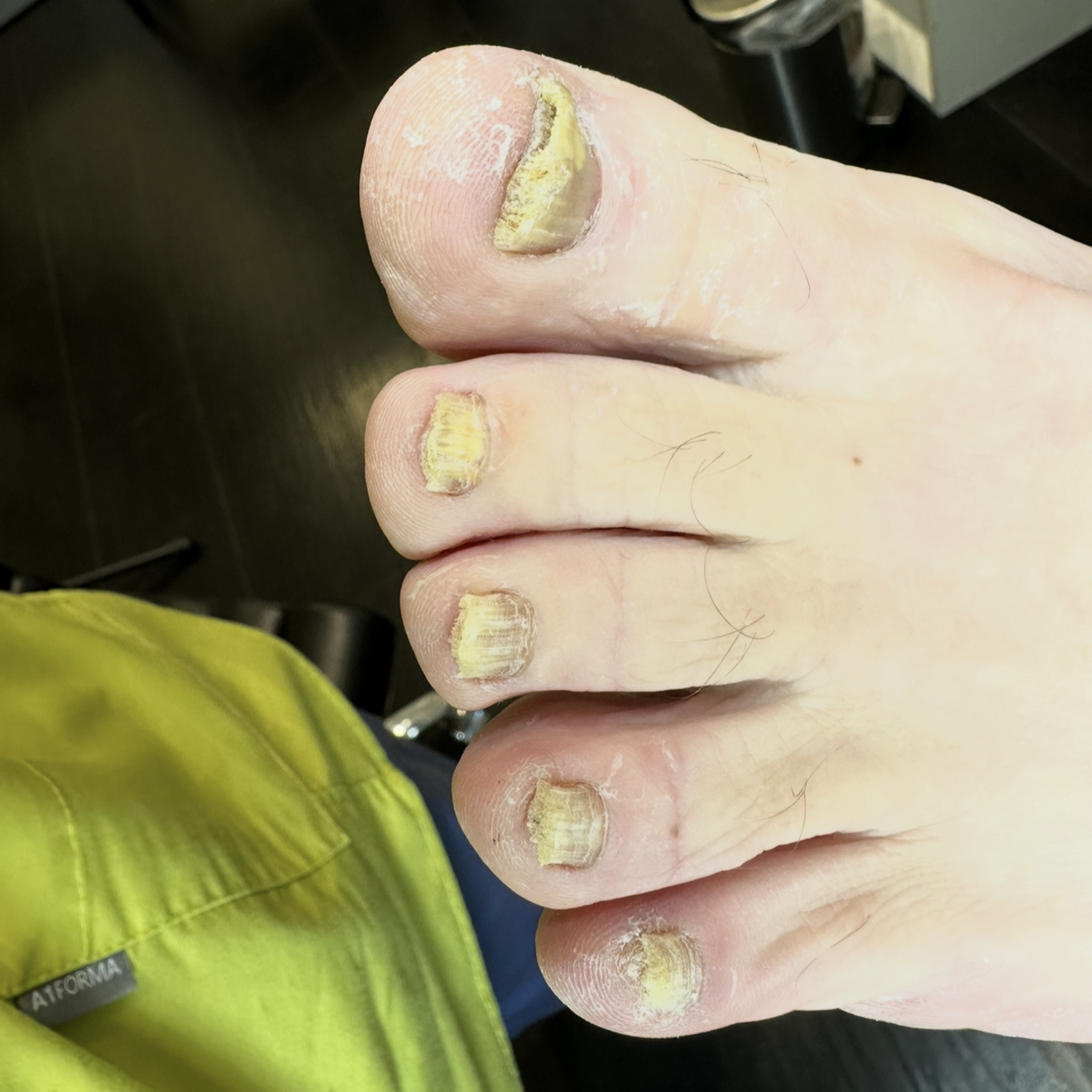 Advanced Toenail Care 1st Category