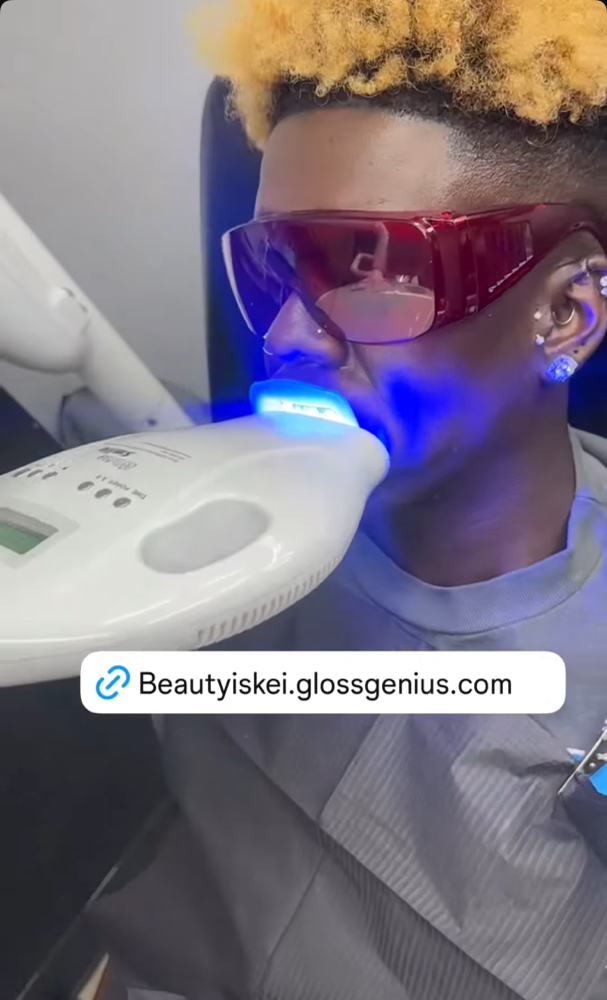 Teeth Whitening Touch Up