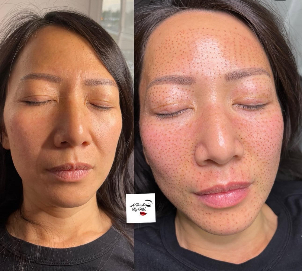 Whole Face Special