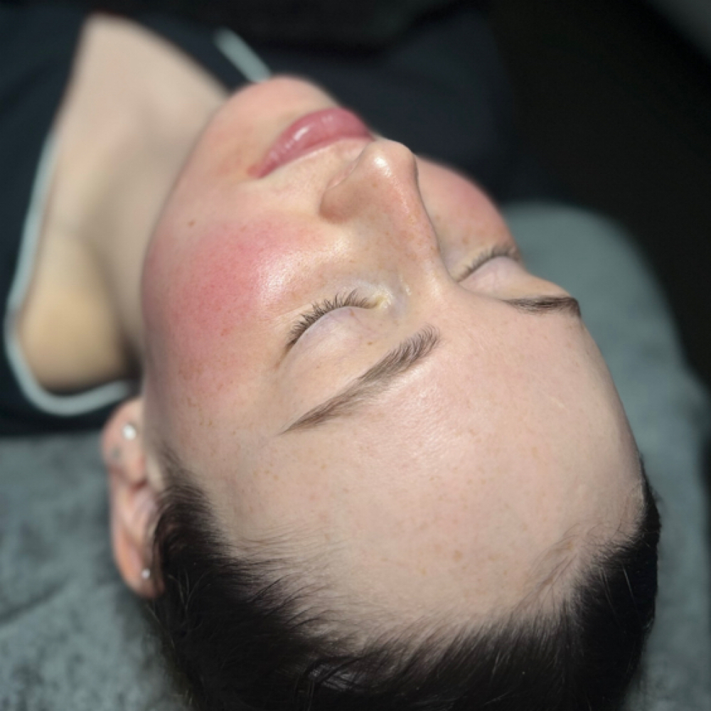 Emerald Peel - March Special at SKINSPOT ADVANCED AESTHETICS in TAUNTON, MA