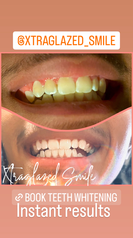 Teeth Whitening at Xtraglazed Therapies and Locs in Richmond, VA