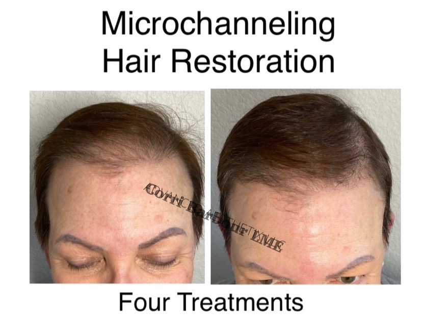 Hair Restoration Treatment