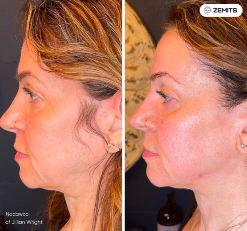 Add-On: FrioLift Neck Treatment