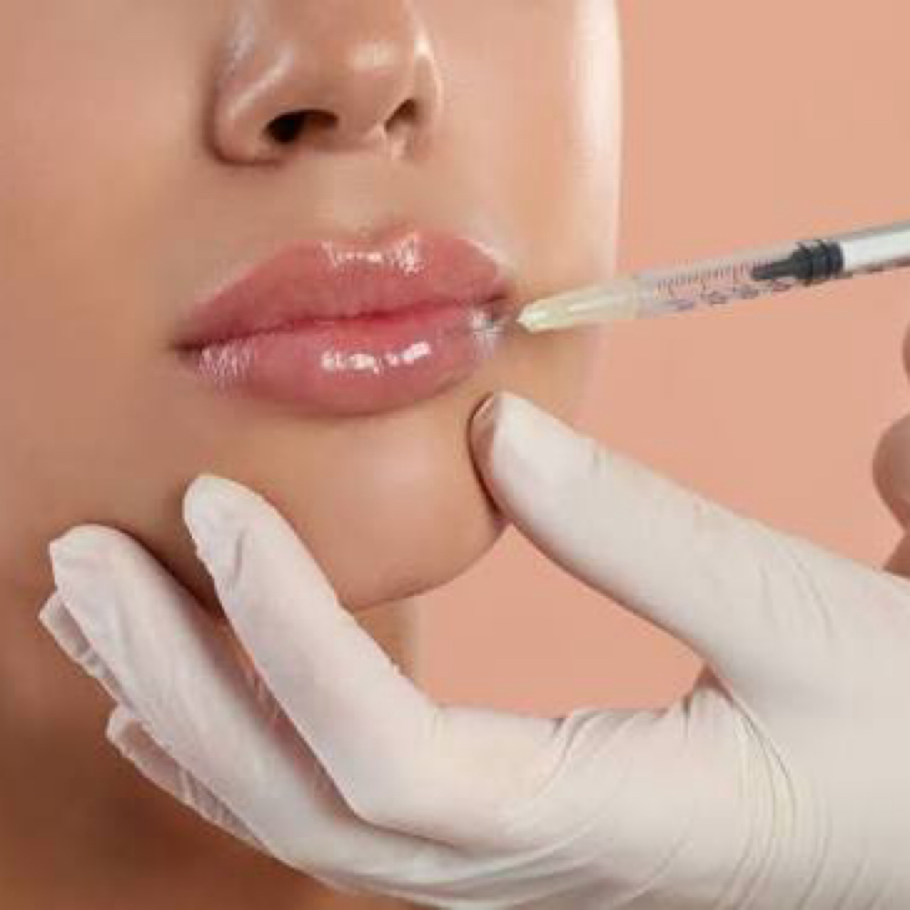 Lip Filler Correction & Dissolving at Golden Glow Aesthetics in Patterson, MO