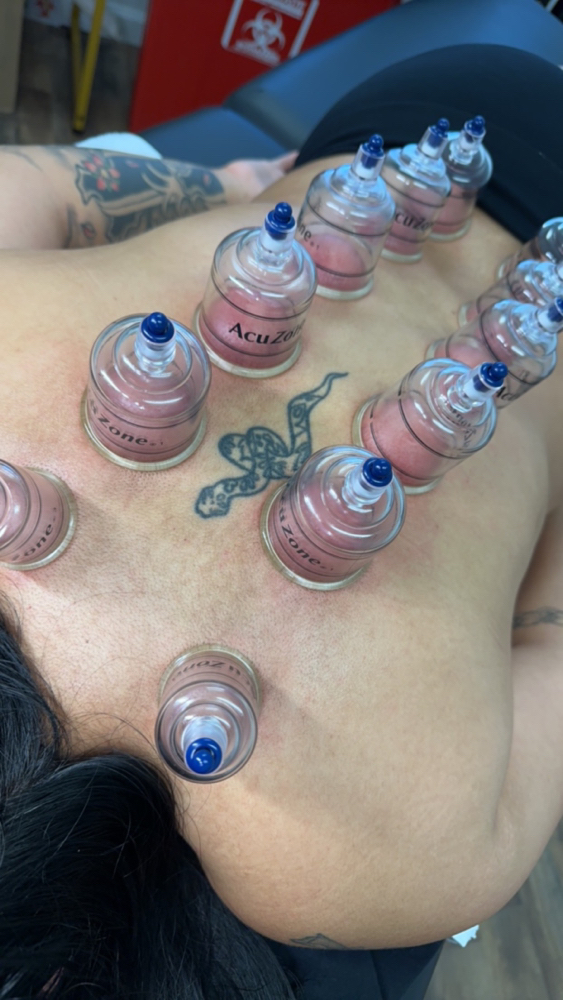 Back Cupping
