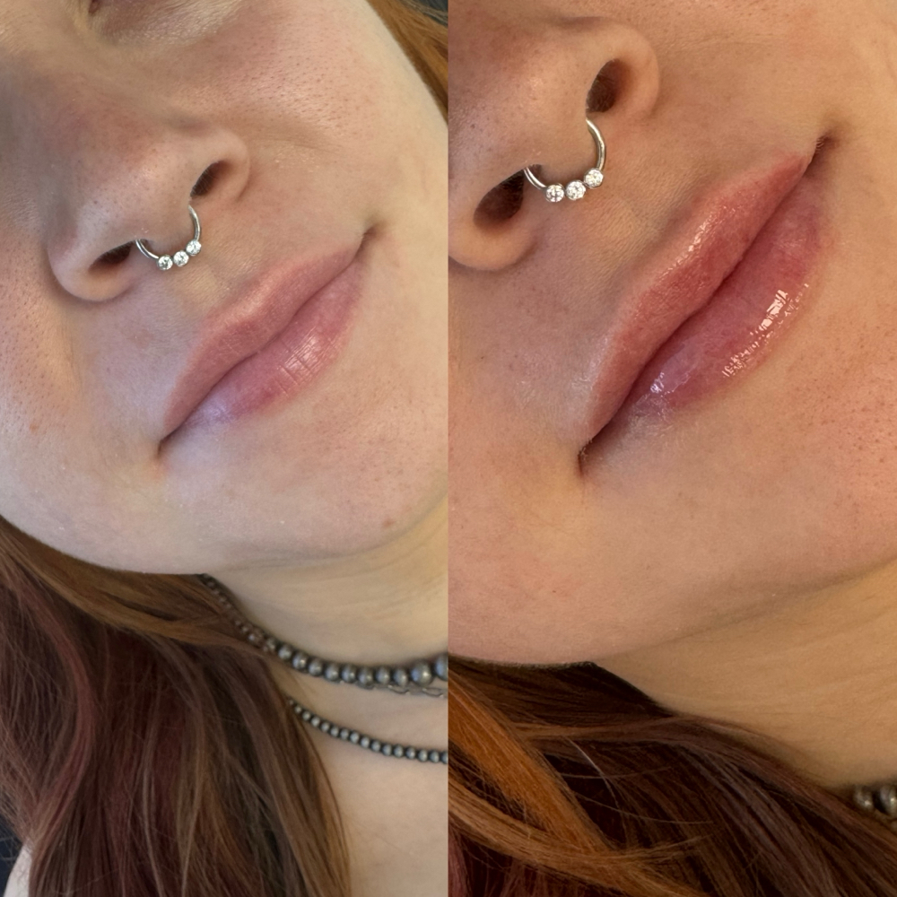 1/2 Lip Filler at Aesthetic Beauty Bar, LLC By Haley in Tyler, TX