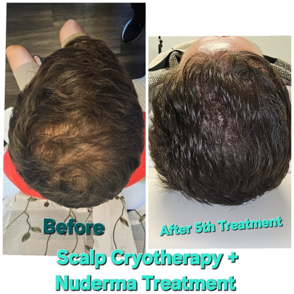 Scalp Treatment (Migraine Relief)