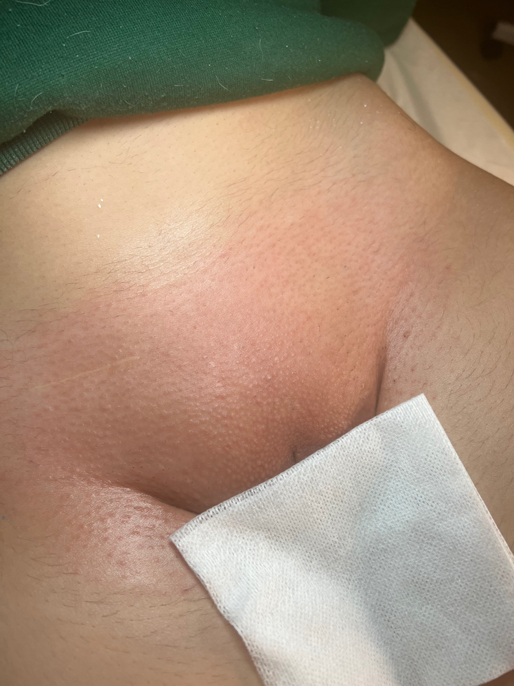 Bikini Full at Golden Vanity Aesthetics in Riverside, CA