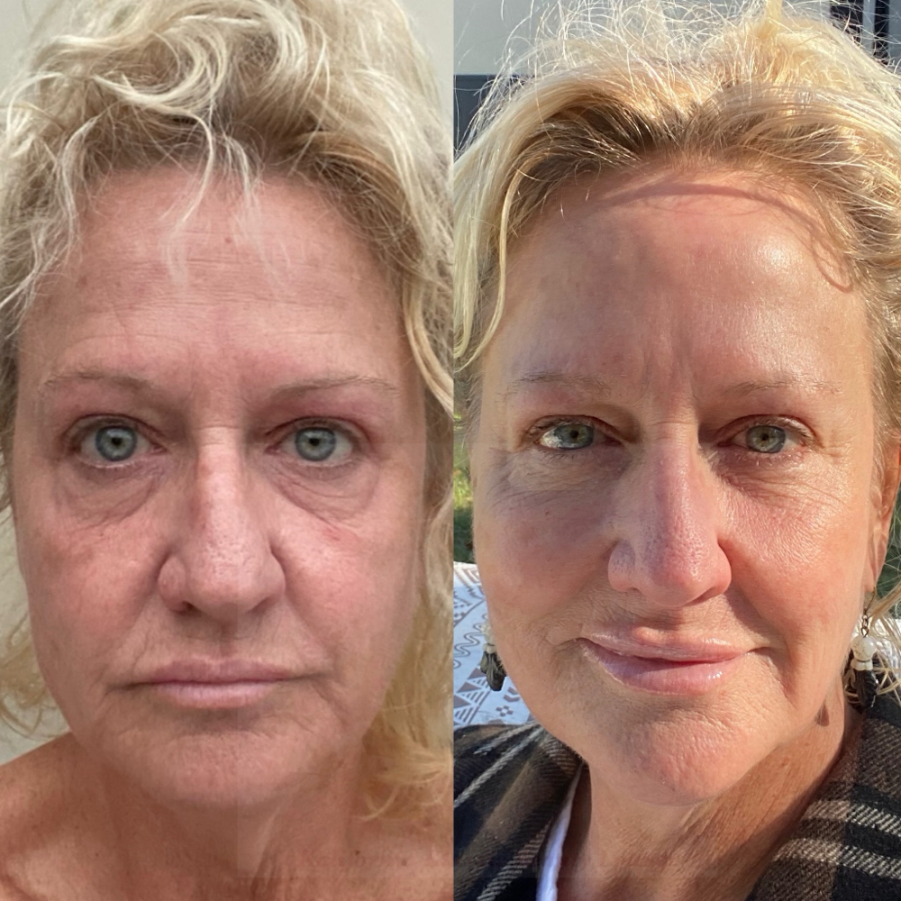 PCL Microneedle Facelift