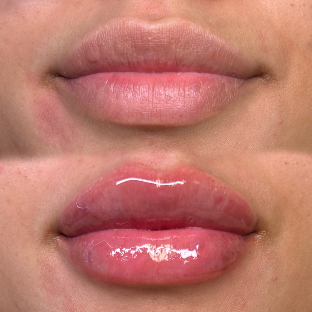 1mL Microneedle Lip Filler at Seduce Beauty & Academy in Houston, TX