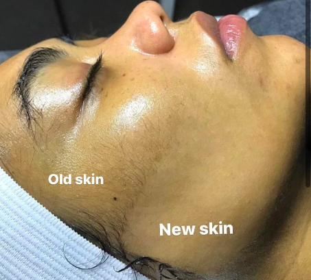 Dermaplane Facial