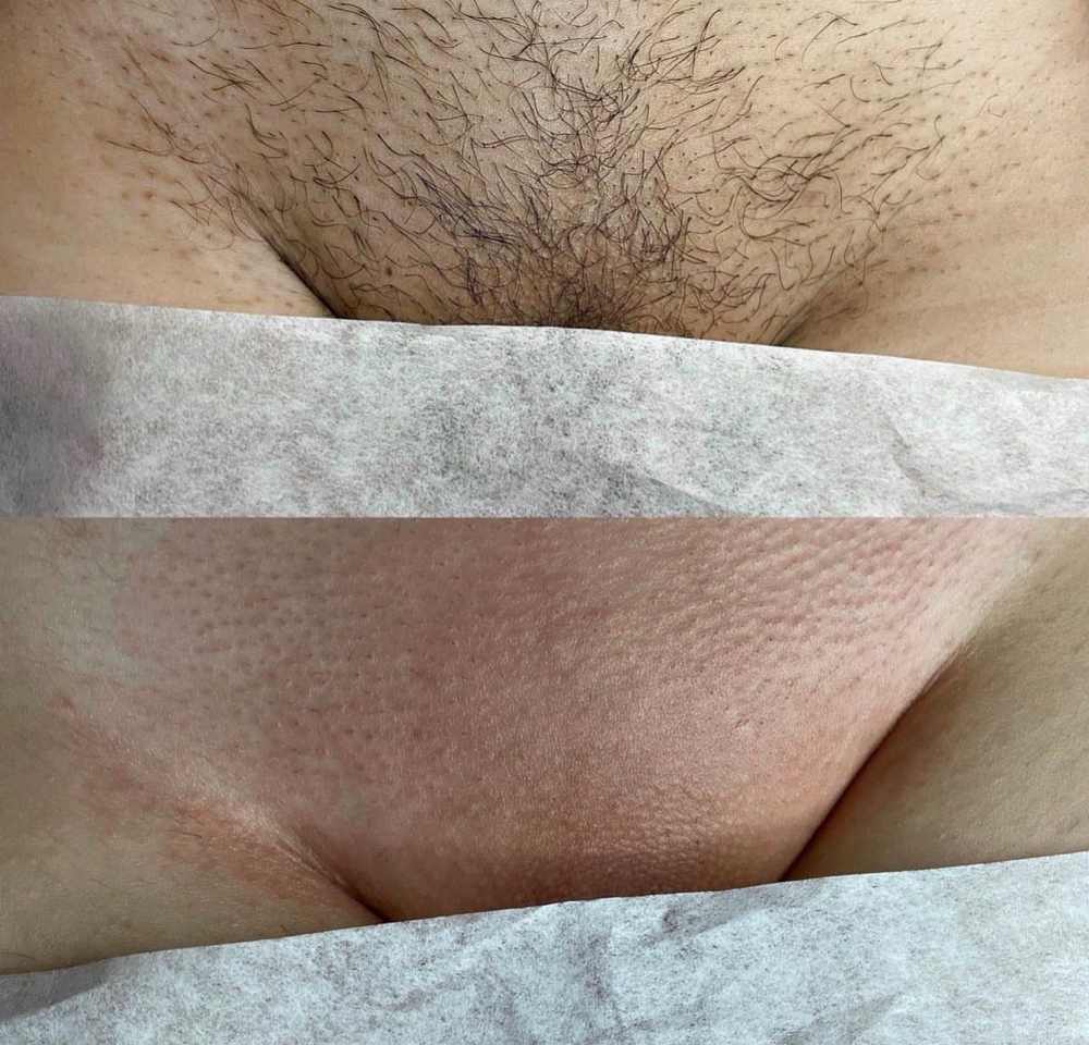 New Client 1st Time Brazillian Wax