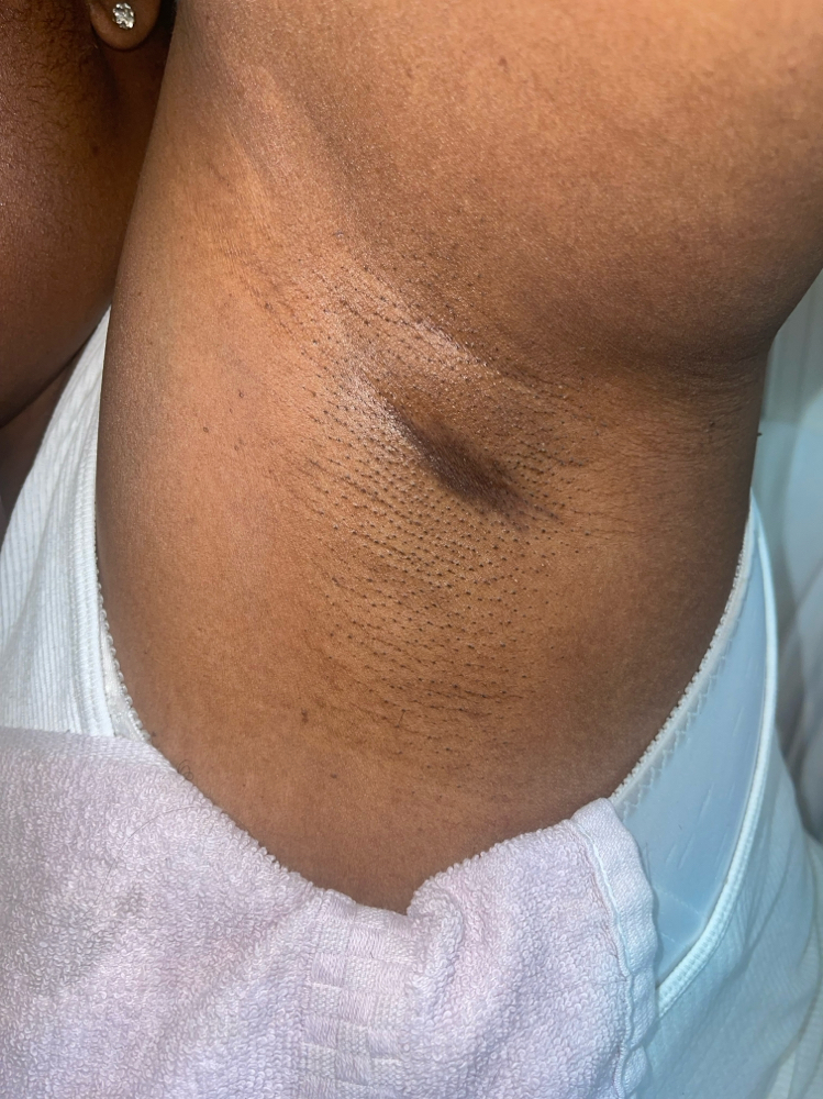 Underarms
