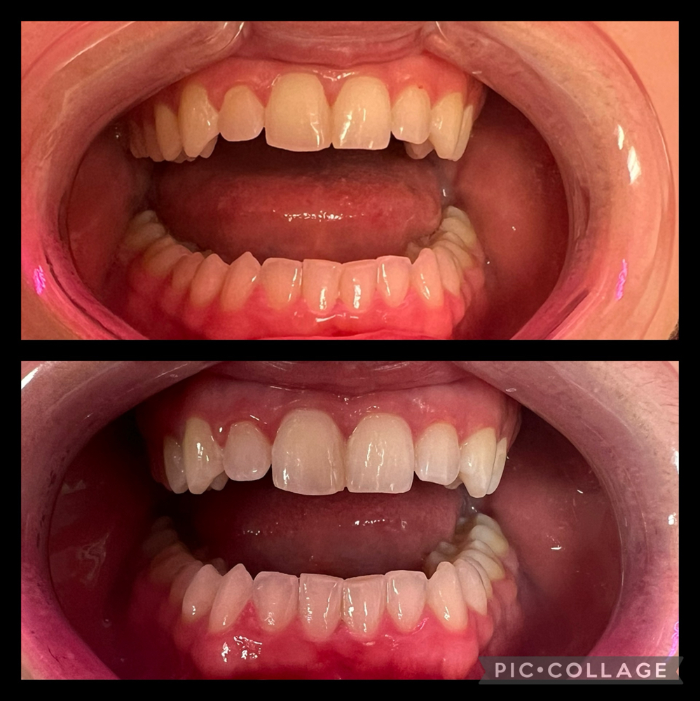 Teeth Whitening