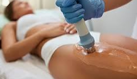 Cellulite Treatment