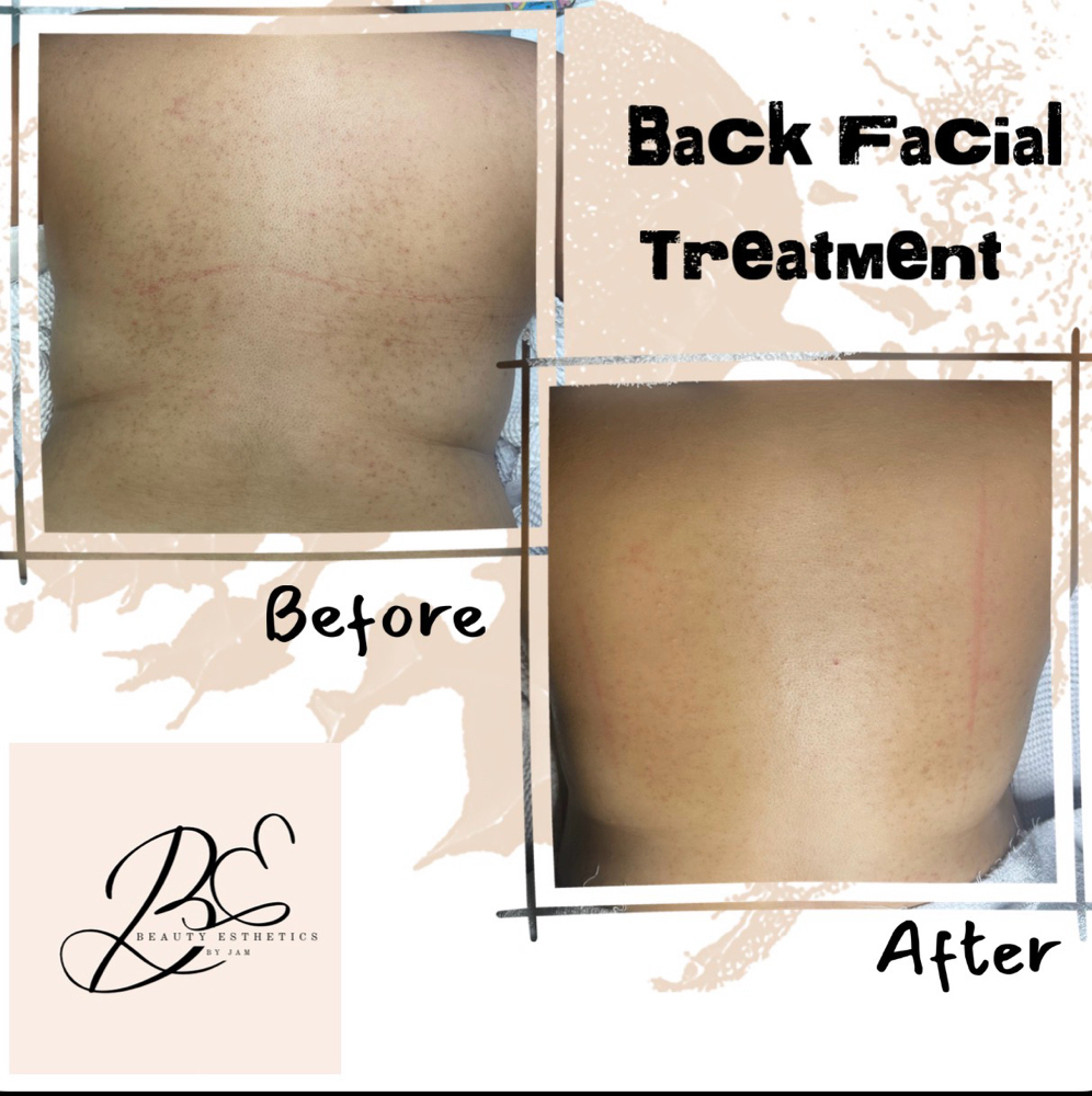 Back Facial Treatment
