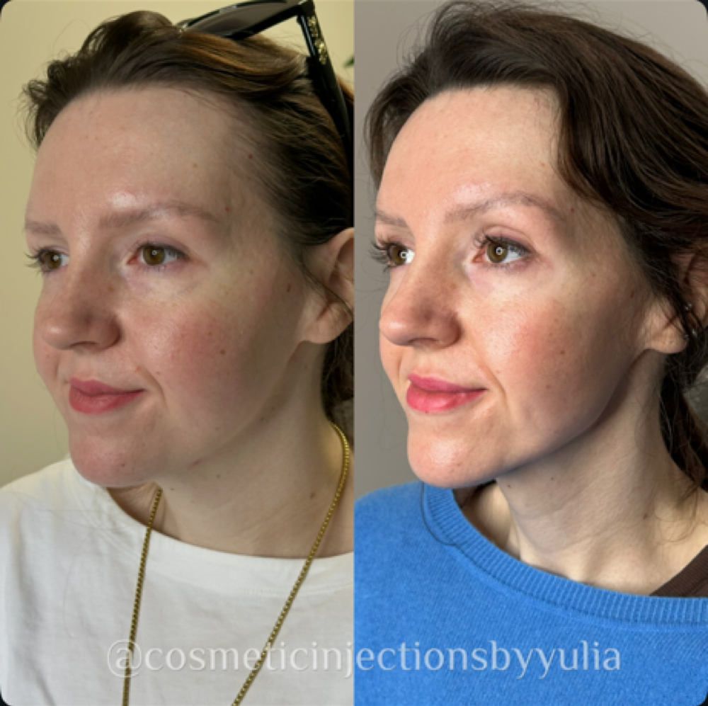 Full-Face Filler + Facial Balancing at Cosmetic Injections By Yulia in Greenfield, MA