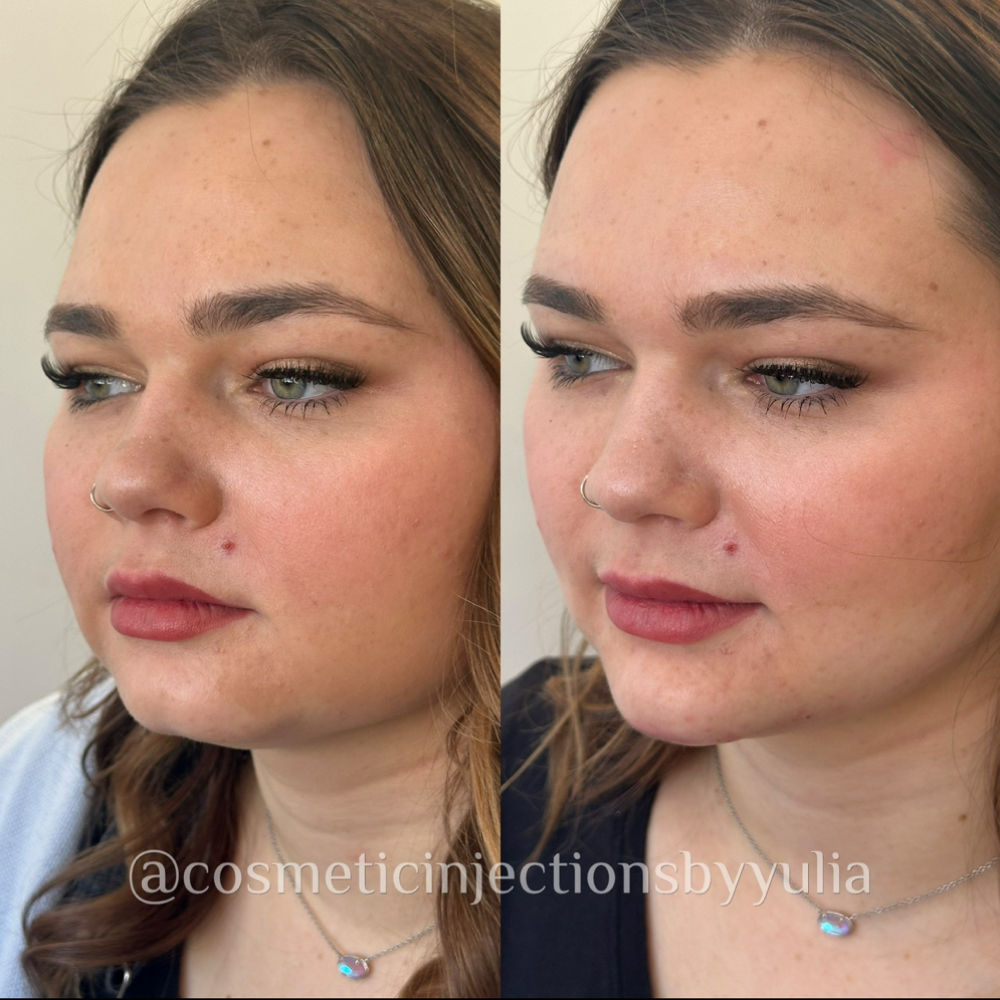 Facial Balancing with Fillers