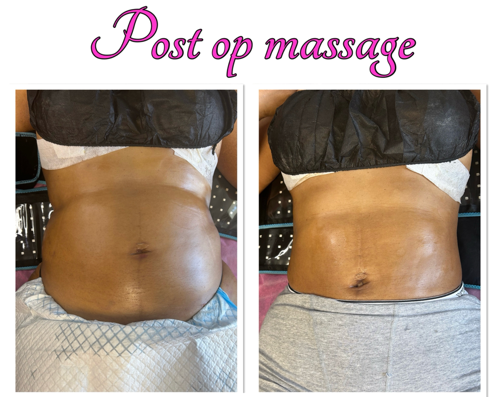 Post Op Massage at Pure Essence Beauty & Body, LLC in Shreveport, LA