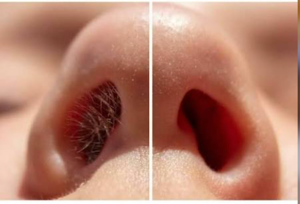 Ear (or) Nose Wax