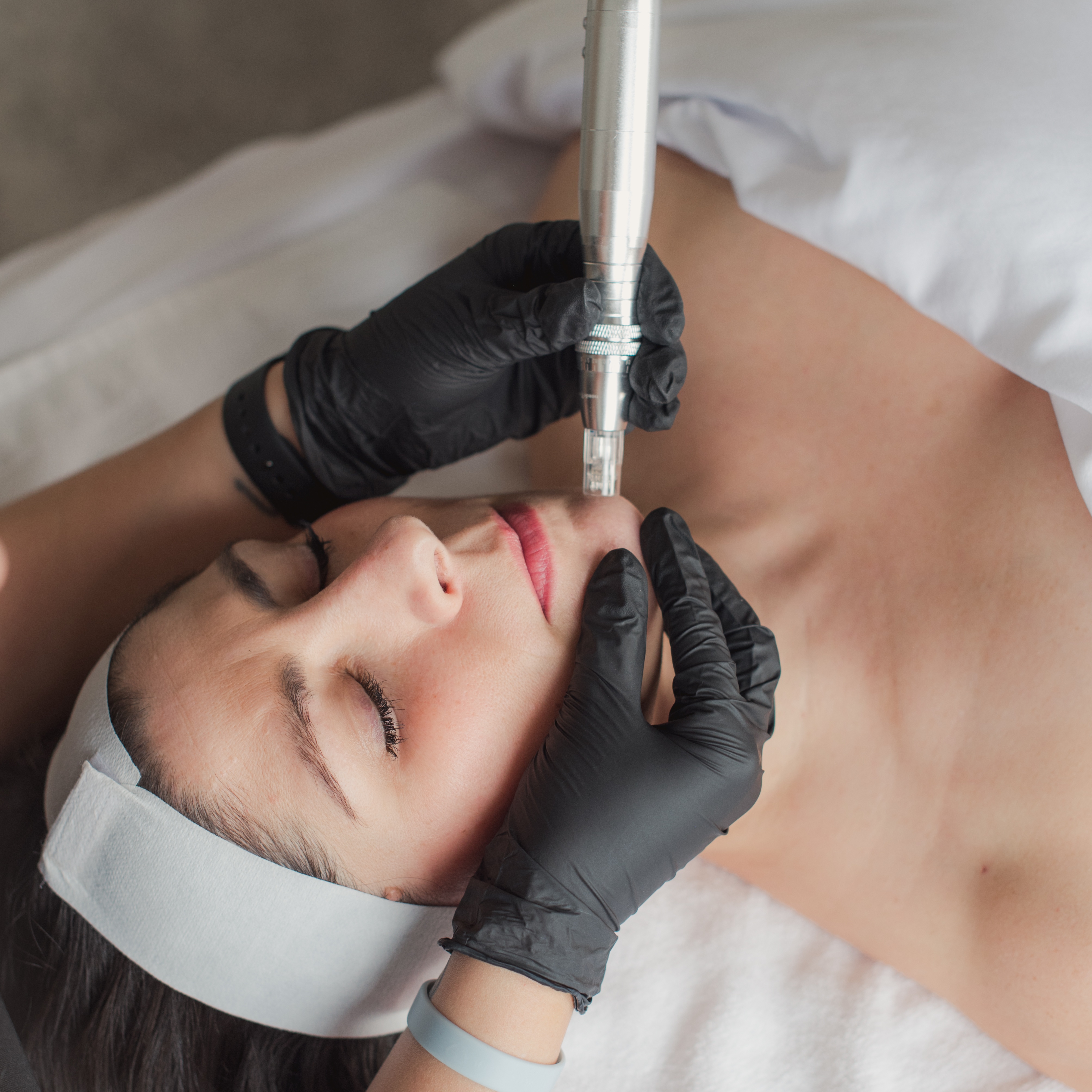 Rejuvenating Micro-channeling at Le Petit Spa in La Center, WA