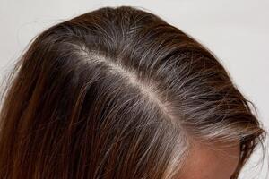 Scalp Pigmentation- Part Line