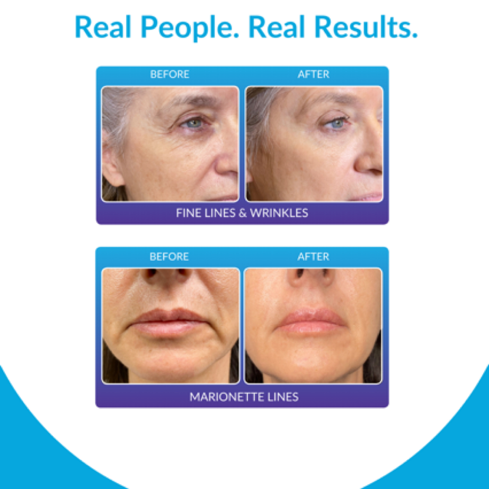 Corrective Facial + procell Bundle