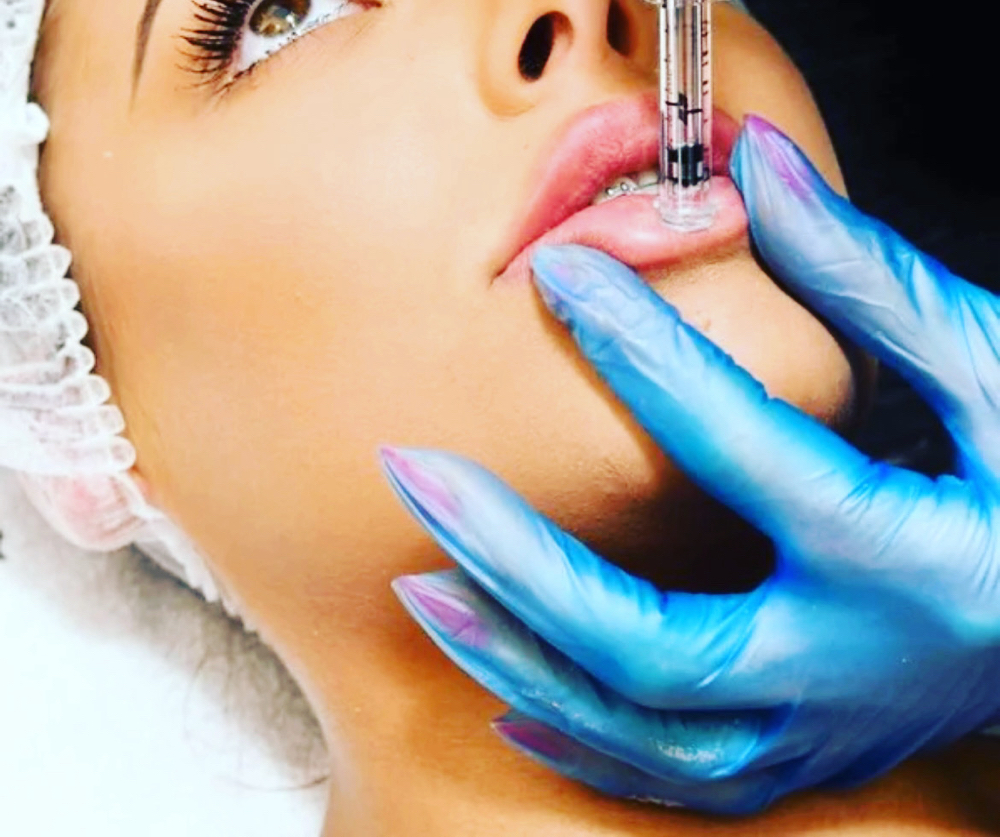 1 Ml Lip Filler