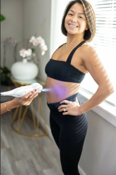 Cryosculpting Abdominal