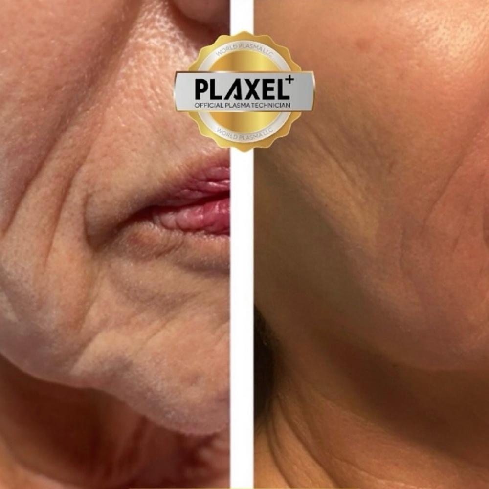 Plasma Skin Refinement at C. Walker Skin Company in Cookeville, TN