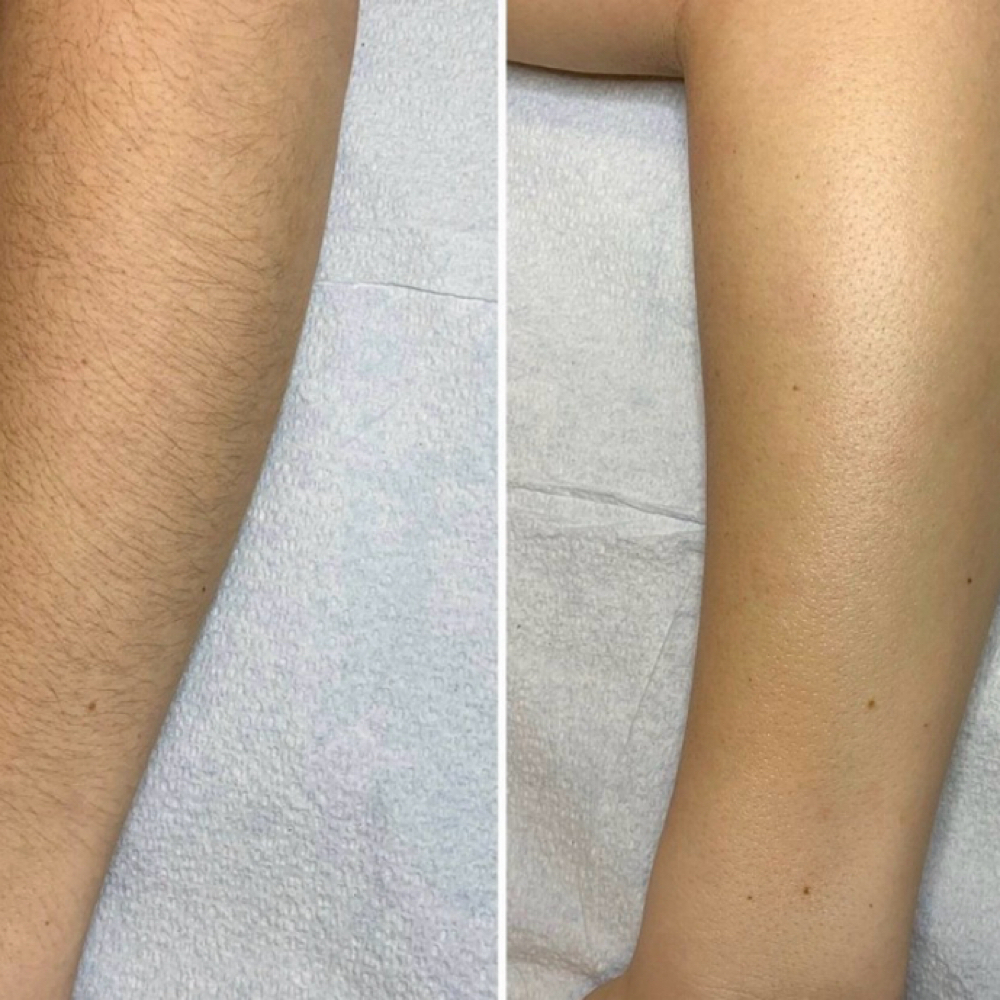Arm Waxing at Poshii GOAT Esthetics in Carmel, IN