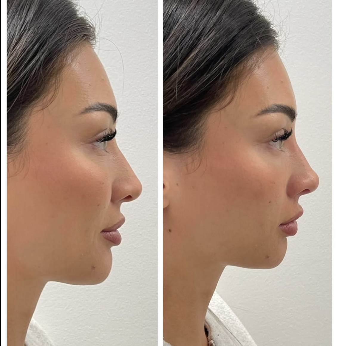 Nose Tip Tox