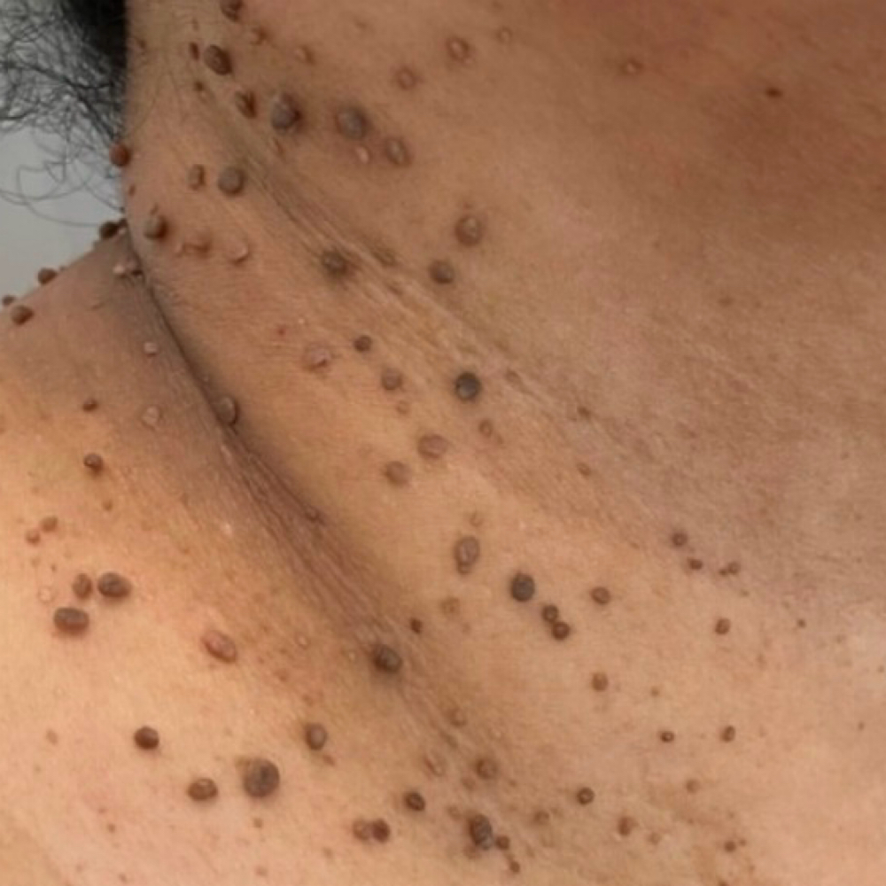 Skin Tages Removal at Sanazskincenter in Vienna, VA