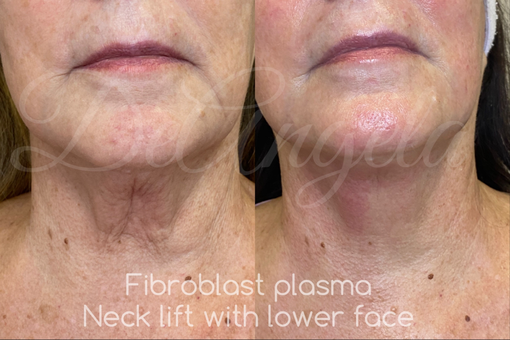 Fibroblast Neck Lift at Faces by DeAngela in New Brockton, AL